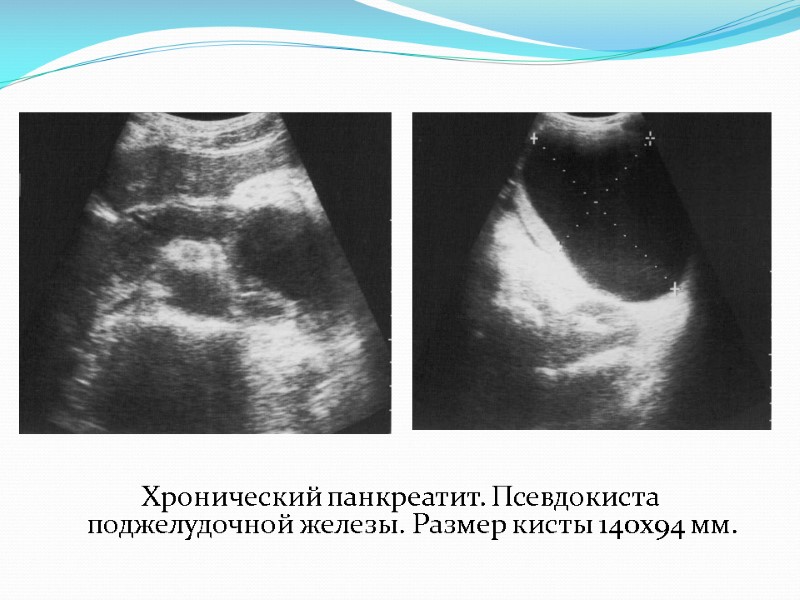 Хронический панкреатит. Псевдокиста поджелудочной железы. Размер кисты 140х94 мм.